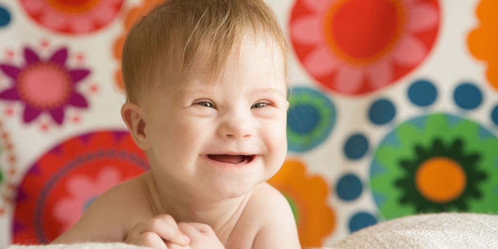 Down Syndrome baby