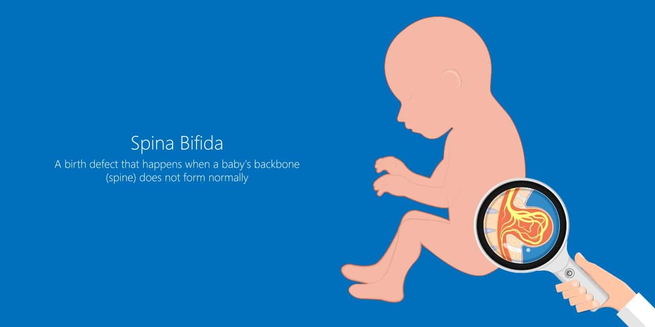 Spina bifida