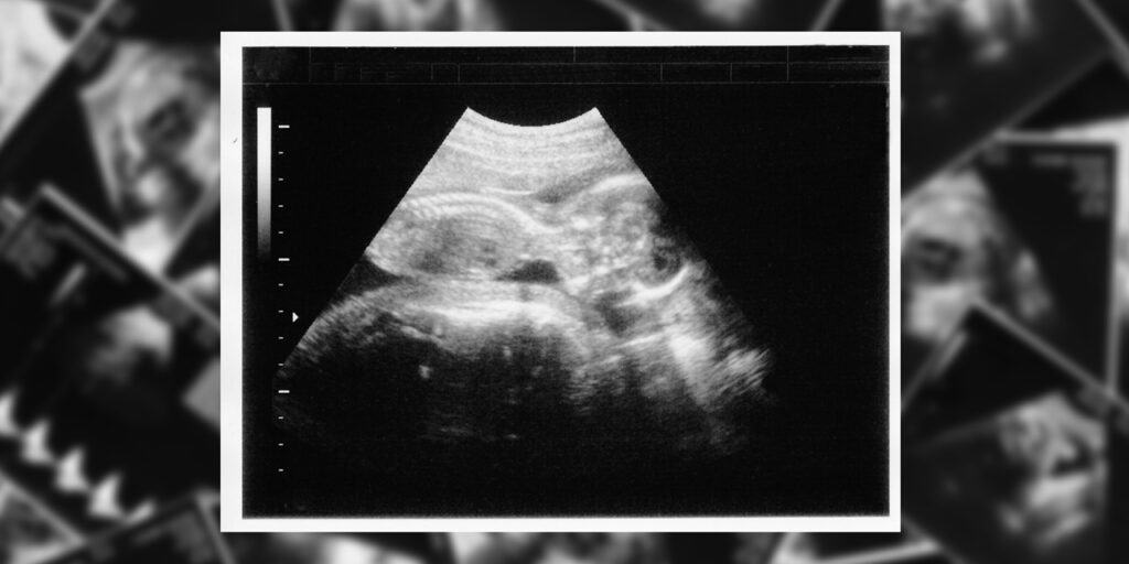 Ultrasound