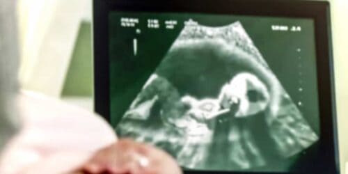 Baby ultrasound