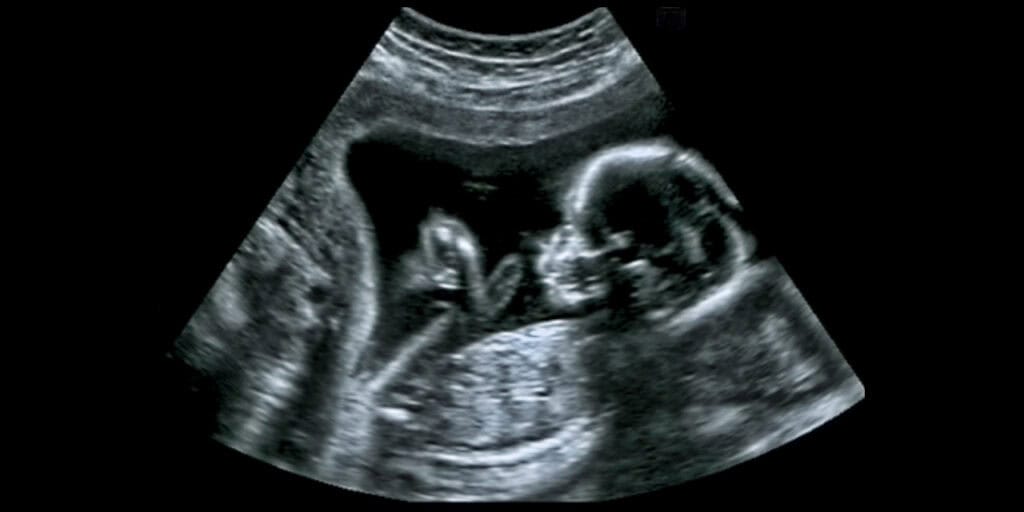 Baby ultrasound