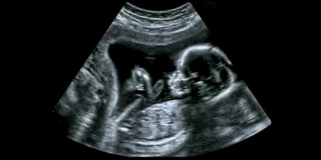 Baby ultrasound